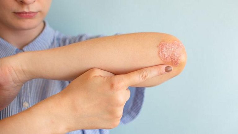 Psoriasi, al via la campagna di prevenzione a Napoli Psoriasi, al via la campagna di prevenzione a Napoli