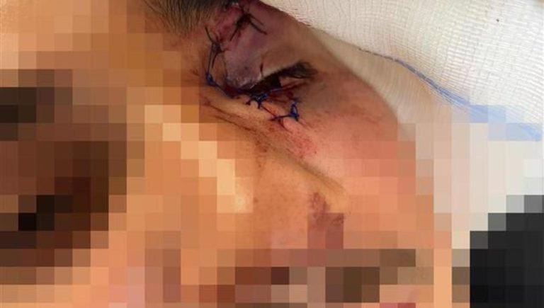 Sedicenne saluta un’amica e l’ex fidanzato gli spacca la faccia. Minore anche l’aggressore: 14 anni